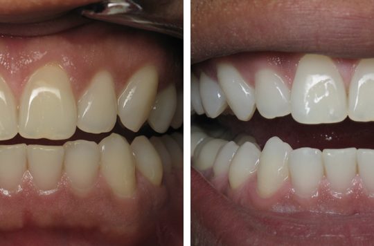 Laser Teeth Whitening Services