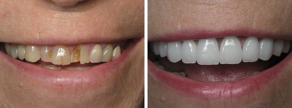 Broken Teeth Before and After