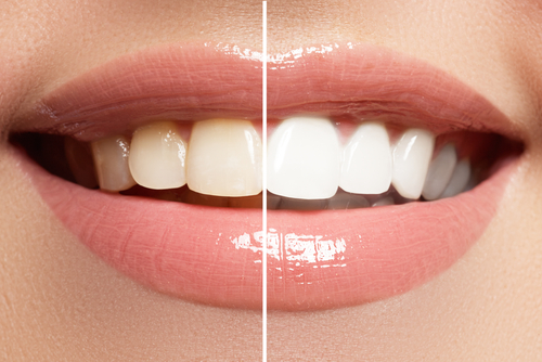 Trinity, FL Teeth Whitening Treatment