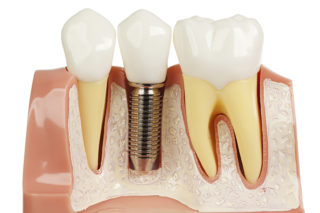 Trinity, FL Dental Implants